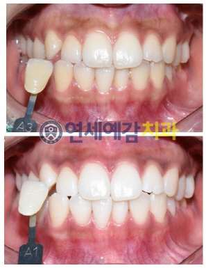 도쿄 일본인치과의사분들께서 저희 서울 시청역 연세예감치과를 방문하여 치아미백을 받으셨습니다. 관련 이미지 7