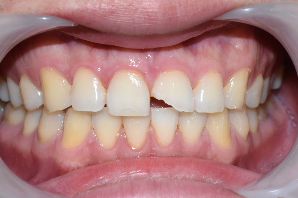 앞니깨짐 실제 치료 사례, 넘어져서 변색된 앞니 깨진 앞니 관련 이미지 1