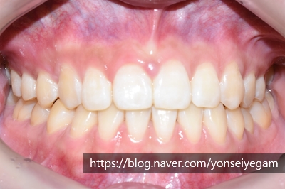 [시청역/광화문]벌어진 앞니 어떻게 치료되었을까요?-부분교정 관련 이미지 2