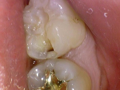 순화동 가까운 충치치료 치과 해외에서도 찾아오는 연세 예감 치과 관련 이미지 8