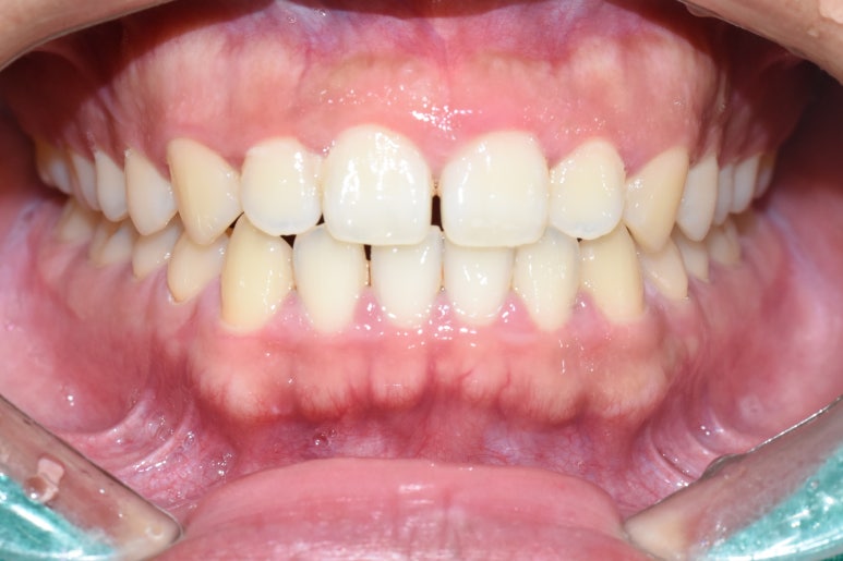 충정로 가까운치과 벌어진 치아사이 레진치료 실제사례 알려드려요 관련 이미지 5