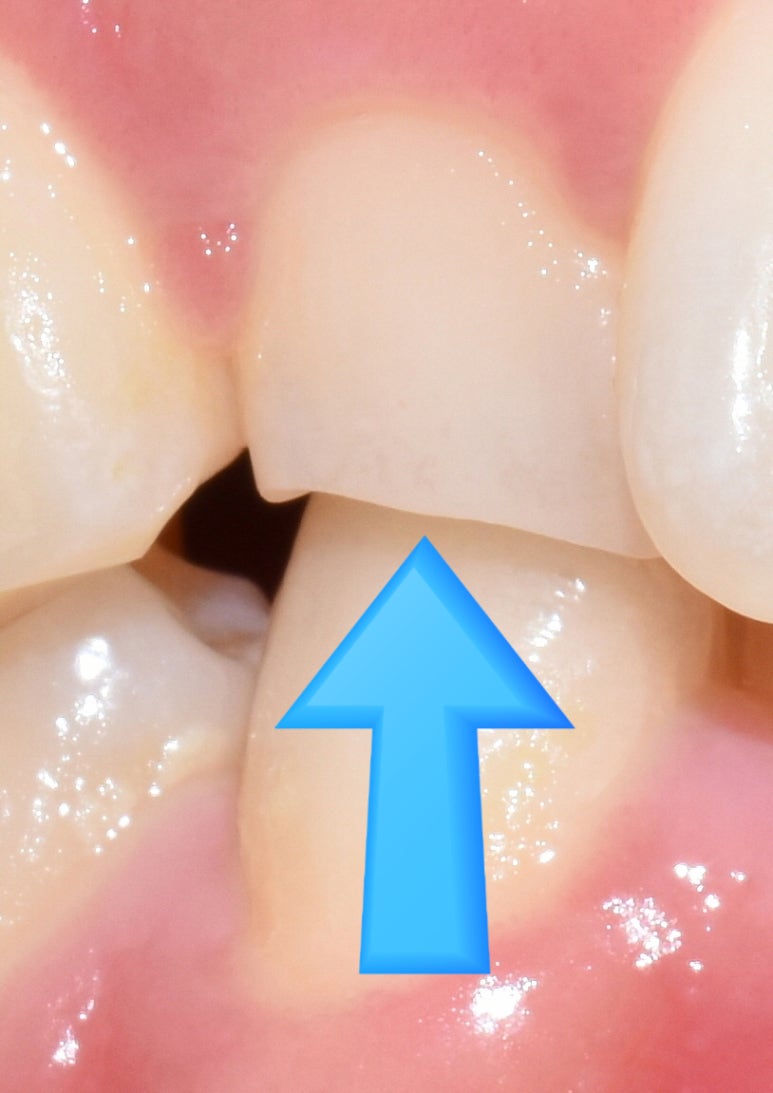 이갈이원인 증가요인 이갈이 치료방법 비용 관련 이미지 1