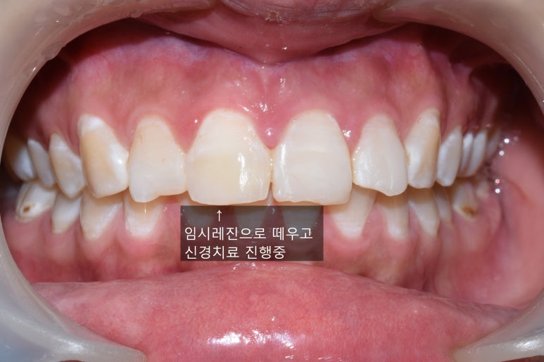 [서대문가까운/치과] 깨진 치아 레진 떼운 사례 관련 이미지 3