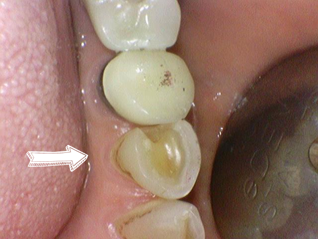 충정로 / 금니, 금크라운, 금인레이,아말감 치아가 보기 싫다면? 치아색 이맥스 인레이,지르코니아 크라운 소개 관련 이미지 4