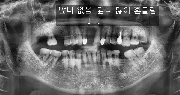 [서울시청역/서울역] 앞니 임플란트 가능할까요? 앞니 내비게이션임플란트 관련 이미지 4