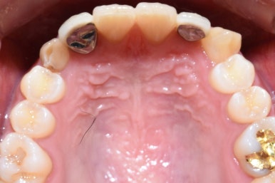 [광화문/시청역 치과]임플란트+크라운 +무삭제 라미네이트 복합 혼합 "6개 앞니 케이스" 소개/라미네이트가격 관련 이미지 2