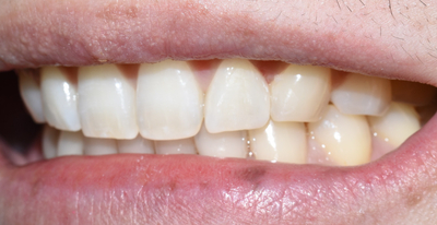 앞니 사이 벌어진 부위 레진치료의 방법 관련 이미지 3