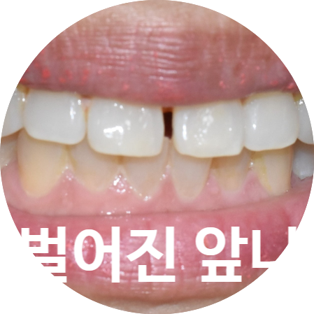 치아 앞니 벌어짐 벌어진 앞니&rarr;레진치료 비용까지 알려드려요 관련 이미지 1
