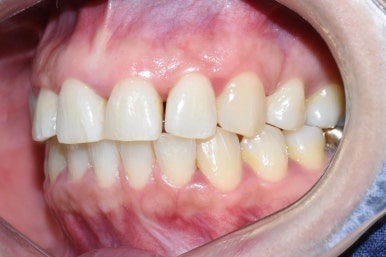 (교정 후에도) 벌어진 앞니 치아 레진으로 간단히 메꾸기 관련 이미지 2