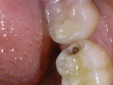 시청역치과 객관적인 근거로 치료하며, 환자분께 치료 전 치료해야하는 이유를 보여드립니다. 관련 이미지 6