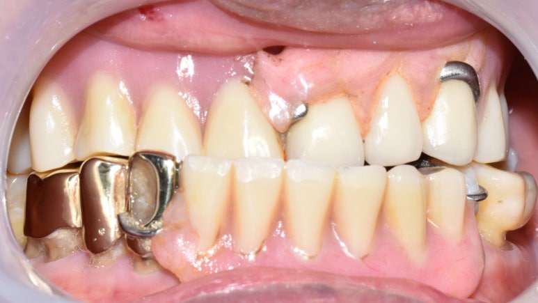 사용중인 틀니가 불편하다면? 임플란트와 틀니가 결합된 임플란트 틀니 추천 관련 이미지 10