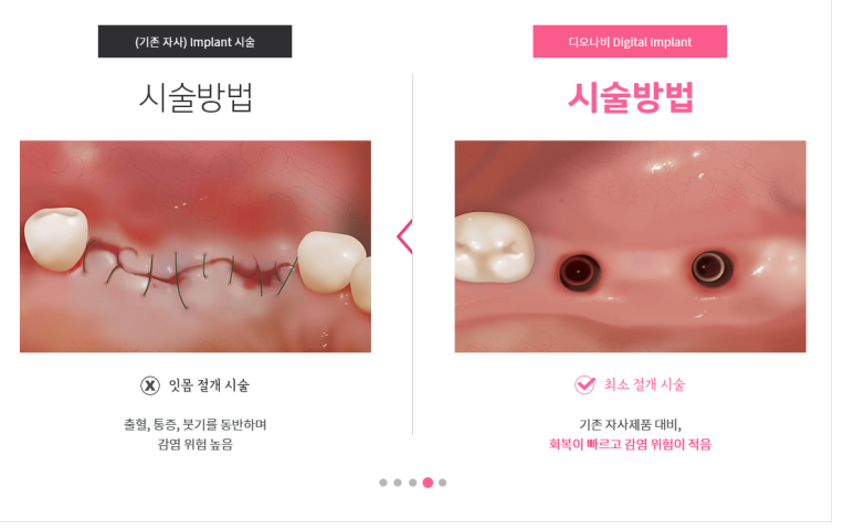 서대문역 가까운 치과 비절개 네비게이션임플란트 소개;덜아프게 빠른 회복위한 관련 이미지 7