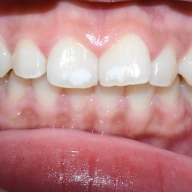 반점치, 반상치, 치아에 하얀 점 치료방법 전후사진, 가격 비용까지 관련 이미지 5