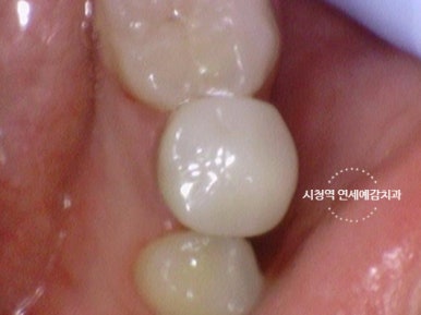 [시청역치과] 미국에서도 크라운 하러 일부러 찾아오는 치과 인증사진 관련 이미지 4