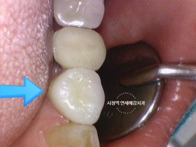 시청역 충정로 충치치료 치과 추천 관련 이미지 12