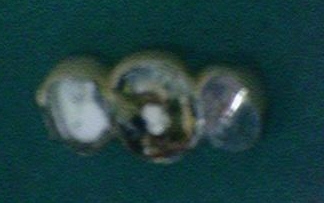 시청역 임플란트&상악동수술?상악동거상술? 어떻게 진행되었을까요 관련 이미지 3