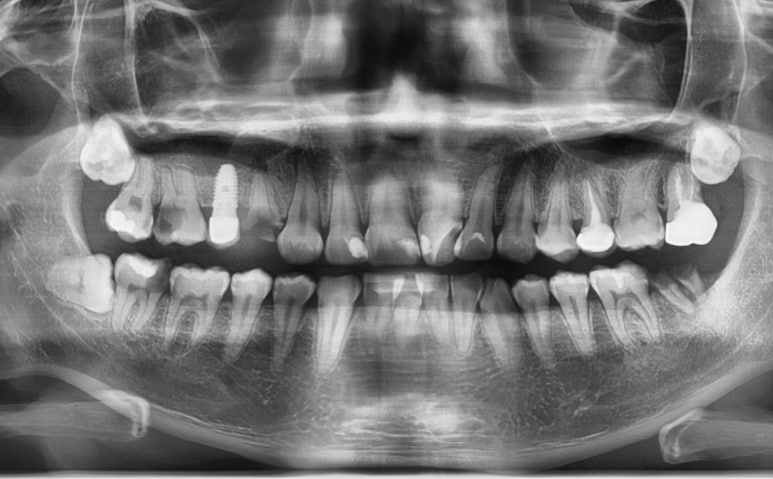 시청역 충정로 충치치료 치과 추천 관련 이미지 2