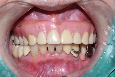 서울 중구 치과/이가 하나도 없는 환자의 치료방법/틀니, 풀아치임플란트, 전체 임플란트 등 관련 이미지 9