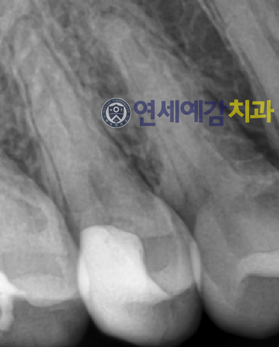 시청역치과 시청치과 자연치아살리기 <연세예감치과> 관련 이미지 8