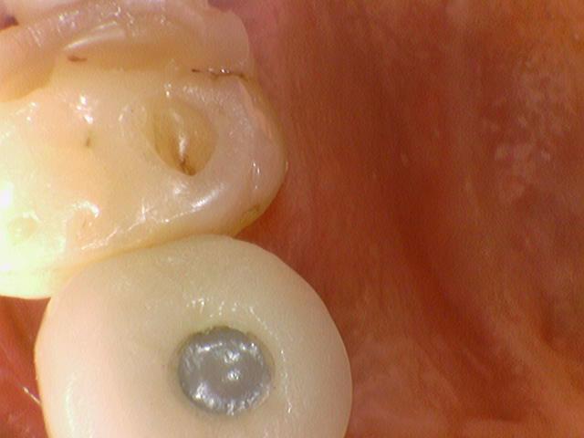 [서울역/광화문] 오래된 크라운에 음식물이 많이 껴요 &rarr;해결방법은? 관련 이미지 2