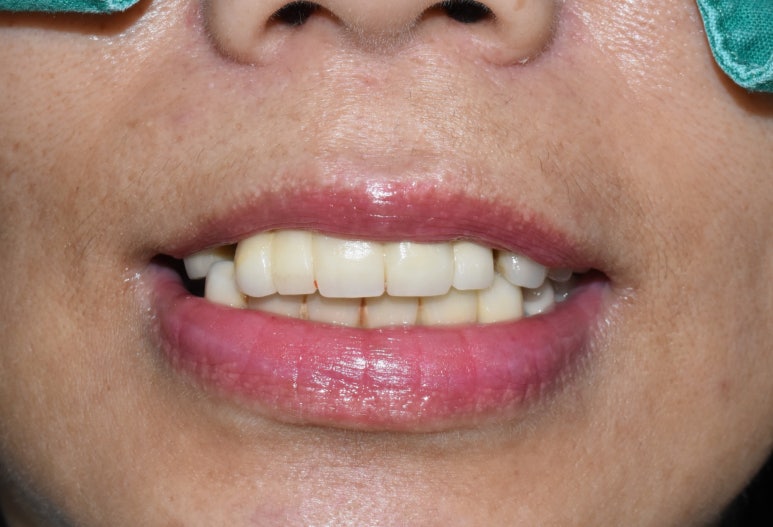 전체 임프란트를 하기 위해 홍콩에서 오신 홍콩인 환자분 관련 이미지 2