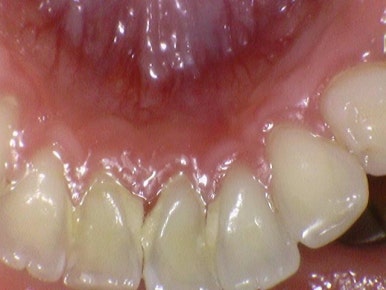 스케일링 처음 받는 분들도 많이 찾아오는 광화문 시청역 삼성본관 바로 앞 치과 관련 이미지 6