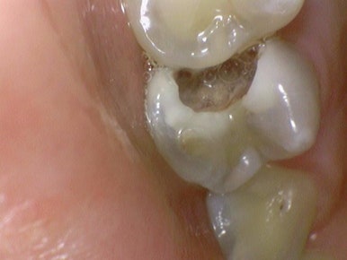 시청역치과 객관적인 근거로 치료하며, 환자분께 치료 전 치료해야하는 이유를 보여드립니다. 관련 이미지 9