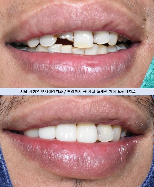 앞니 하나가 부러졌어요 앞니 크라운 앞니 브릿지 관련 이미지 11