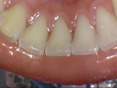 11월, 연말전에 꼭 해야할 일, 왜 스케일링을 빨리 해야하는지 알려드립니다 관련 이미지 3