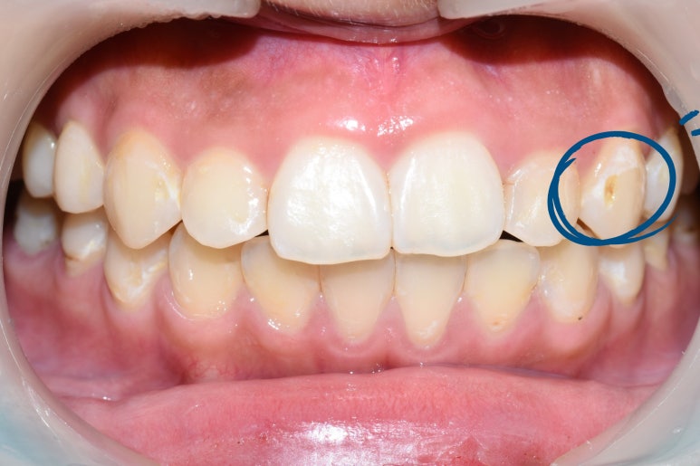[서울역/시청역] 충치 & 화이트 스팟 (반점치) 의 레진치료케이스 관련 이미지 3