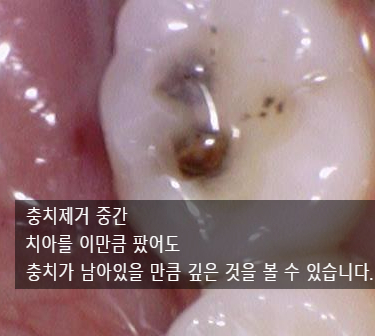 [충정로/치과] 인레이해야한다고 진단받으셨나요? 이맥스(세라믹)인레이 실제케이스 같이 살펴보아요 관련 이미지 6
