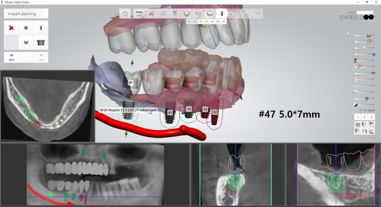 시청역 광화문  최소절개 또는 비절개로 가능한 네비게이션 임플란트 유명한 치과 내비게이션소개드려요 관련 이미지 15