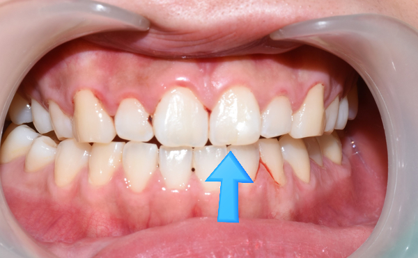 [서울역/시청역] 레진치료 : 화이트스팟(반상치) 케이스 & 치아패임으로 시린 케이스 & 깨진 치아 케이스 관련 이미지 8