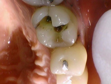 [을지로가까운치과]아말감충치 치료사례 아말감 주변 2차충치를 레진/인레이/크라운으로 치료 관련 이미지 5