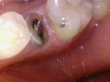 신경치료 끝났는데 크라운 해야하나요? 자연스러운 지르코니아 크라운 유명한 치과 가격까지 관련 이미지 4