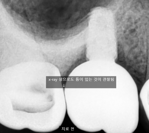 시청역치과 [Q&A]다른치과에서 한 인레이,크라운,임플란트에 음식물이 껴요 관련 이미지 2
