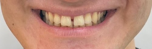 앞니가 벌어진 치아치료 사례: 라미네이트(치아삭제없는 무삭제프리네이트) 관련 이미지 3