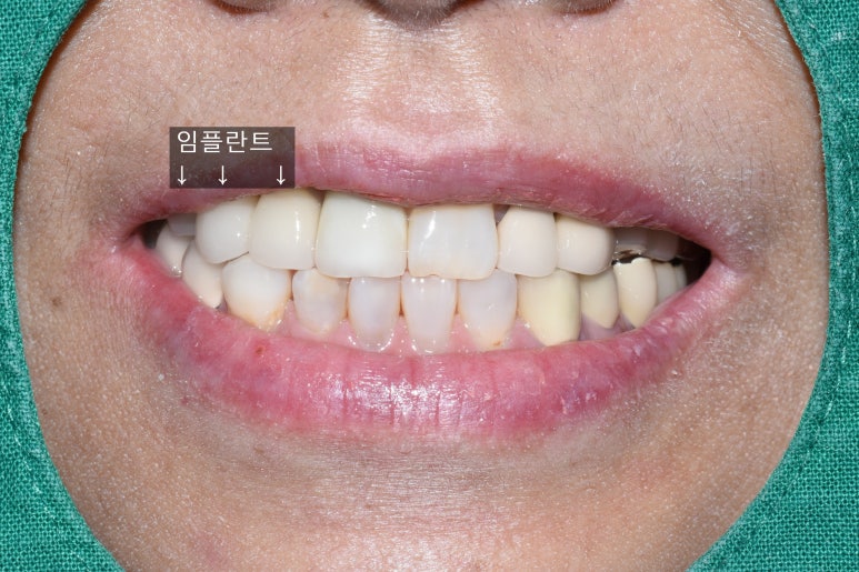 앞니 여러개 임플란트 잘하는 치과 서울역치과 실제사진 관련 이미지 6