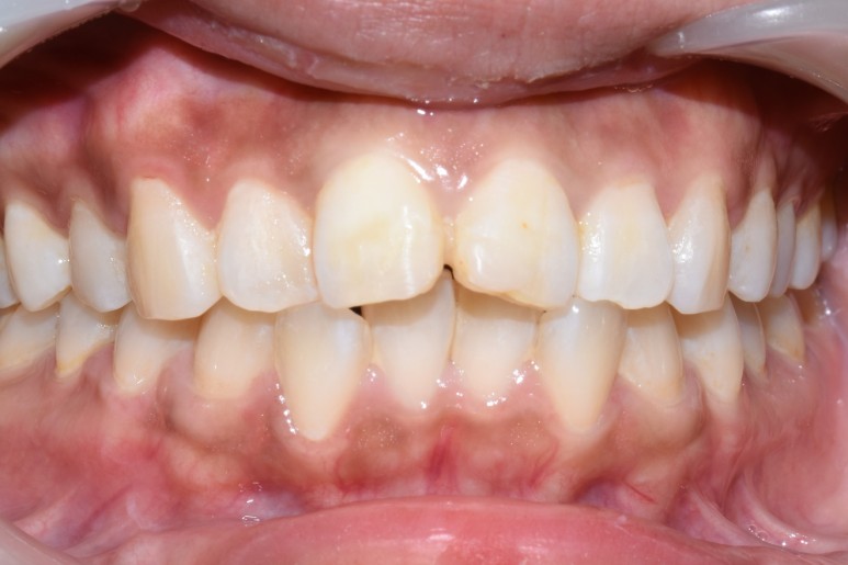 [시청역/서울역 치과] 앞니 치아부러짐 자연스럽게 치료사례 관련 이미지 2