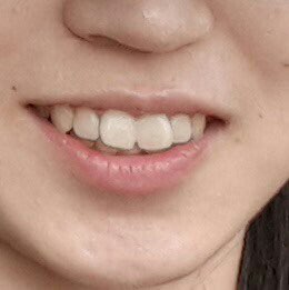 시청역치과 연세예감치과의 2번만의 내원으로 완성되는 고른앞니 만들기 케이스 소개 관련 이미지 4