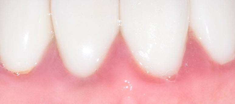 라미네이트 후 잇몸 괜찮을까요? & 라미네이트를 다시 제거하고 원래 치아상태로 쓸 수 있나요? 관련 이미지 2