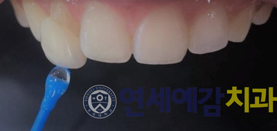 치과의사는 가족에게는 라미네이트 안한다고요? 저희 치과의사선생님은 본인 이에 직접 "프리네이트"하셨어요! 관련 이미지 7