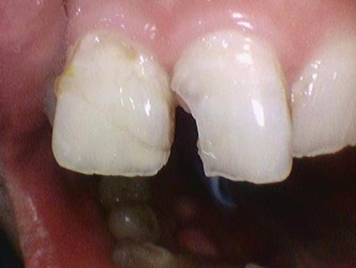 [광화문/연세예감치과] 앞니 치아가 파절되었다면? 앞니 부러짐.레진/크라운/임플란트 관련 이미지 7