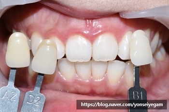 [서울시청역/광화문]치과에서 하는 원데이 치아미백, 연세예감치과에서 알려드려요 관련 이미지 7