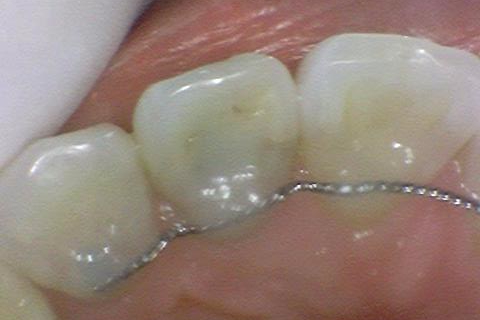 앞니가 변색이 있어서 크라운을 해야하는데 뒤에 교정 유지장치가 붙어있다면? 관련 이미지 3