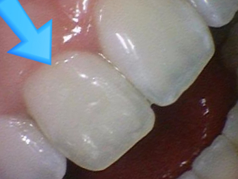 [서울 광화문/남대문] 화이트스팟 레진으로 치료케이스, 비용안내 등등 / 반점치, 반상치 관련 이미지 3