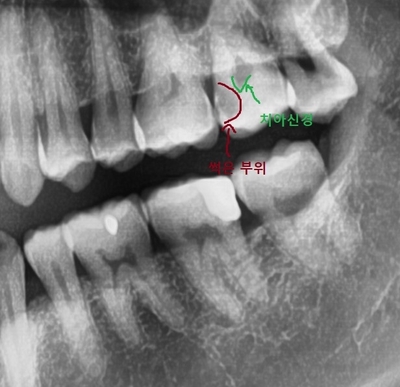 치과의사가 받은 치아치료 & x-ray와 검진의 중요성 관련 이미지 2