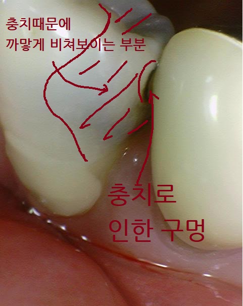 [충정로/치과]신경치료 할 만큼의 충치 제거 과정 공개 관련 이미지 2