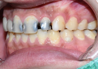 시청역치과 치아가 부러졌어요 치아가 너무 많이 썩어서 앞니가 거의 없는 치아의 크라운 케이스 관련 이미지 4