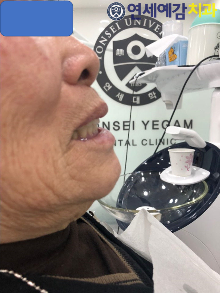 서울 틀니제작, 틀니치료 실제 예입니다. 시청역<연세예감치과> 관련 이미지 8